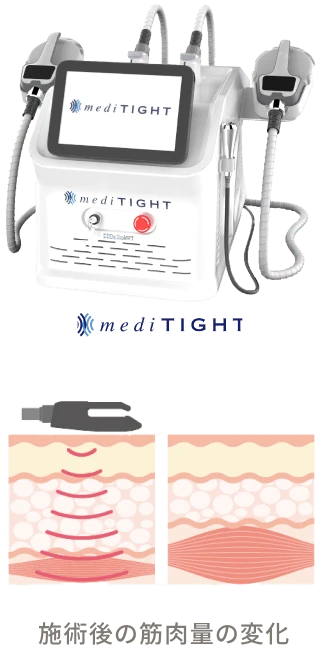 痩身マシンの写真と、施術後の筋肉量の変化のイラスト